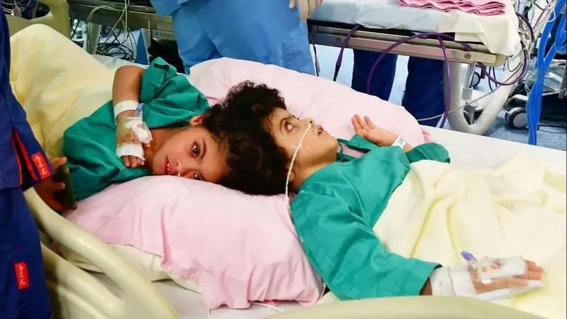 ريادة عالمية سعودية في فصل التوائم السيامية