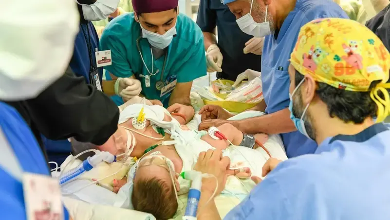 بعد نجاح عملية "مودة ورحمة".. ما هي أول جراحة ناجحة لفصل التوائم في التاريخ؟