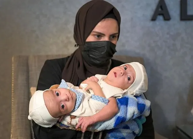 ريادة سعودية في فصل التوائم السيامية