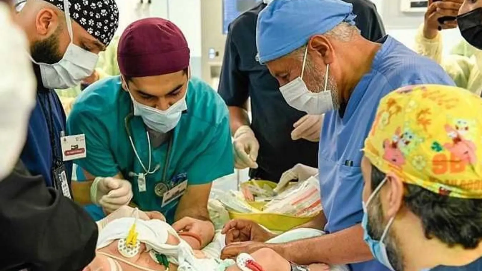 فيديو| بعد نجاح فصل التوأم السيامي اليمني.. هكذا علق قائد الفريق الطبي
