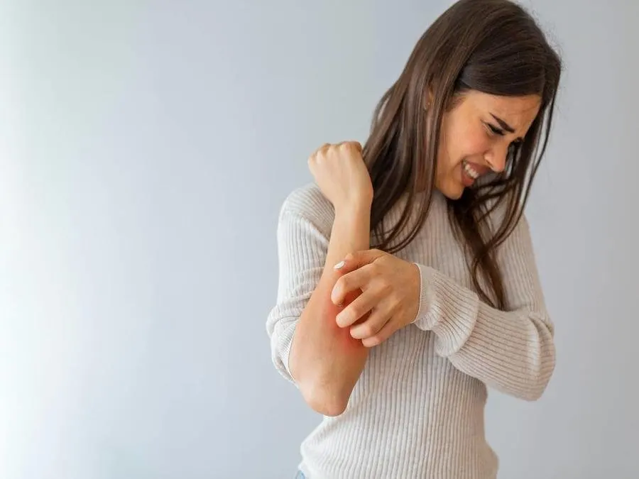 في اليوم العالمي للصدفية.. مسبباتها وأعراضها وطرق علاجها