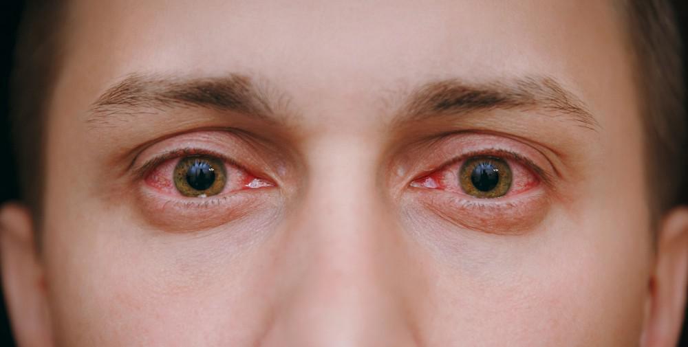 العين حمراء بسبب التهيج