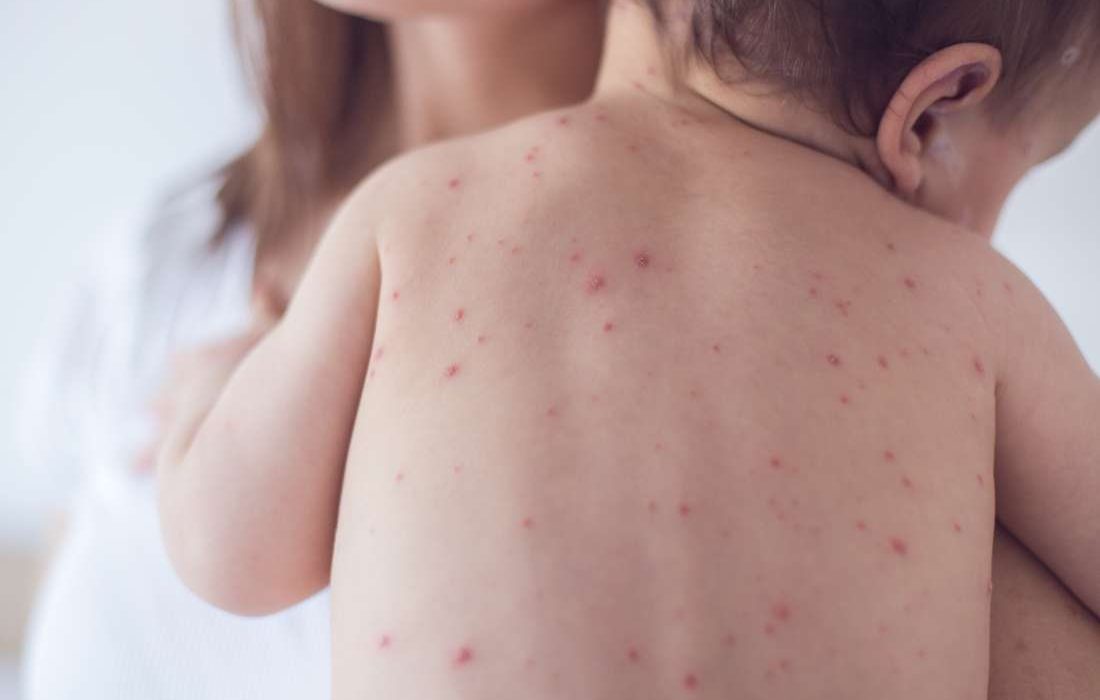 بعد أول وفاة أمريكية منذ عِقد.. أسباب وأعراض "الحصبة"